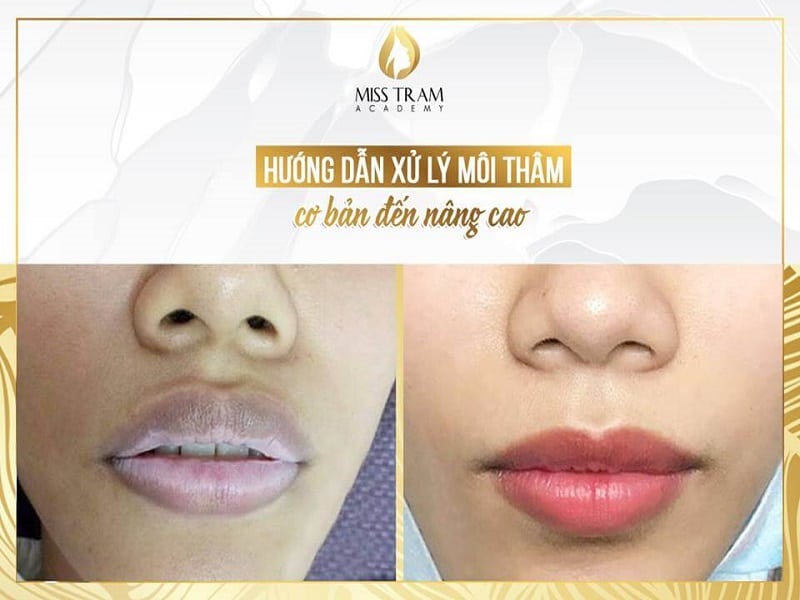 Môi Không Thâm Có Cần Xử Lý Môi Khi Làm Không? - Môi Không Thâm Có Cần Xử Lý Môi Khi Làm Không? Môi Không Thâm Có Cần Xử Lý Môi Khi Làm Không?